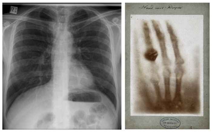 การค้นพบ X-Rays